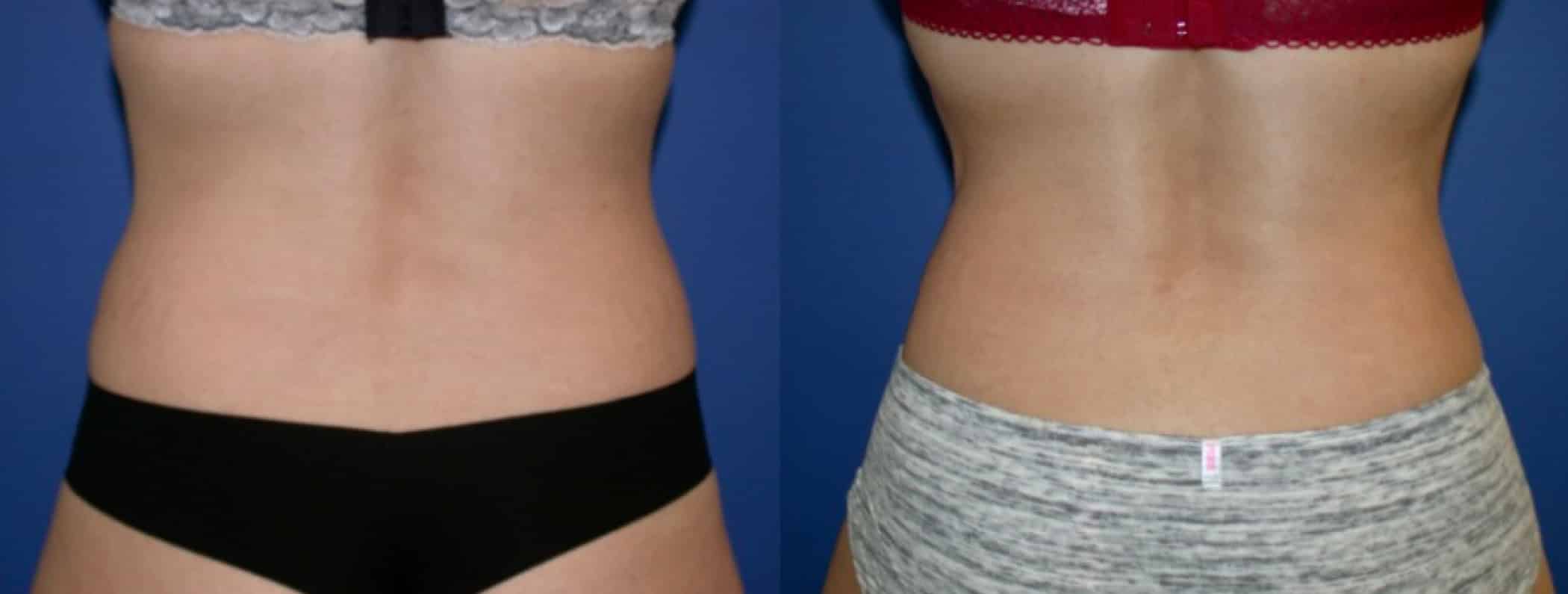 Before and After Image: Tummy Tuck - back
