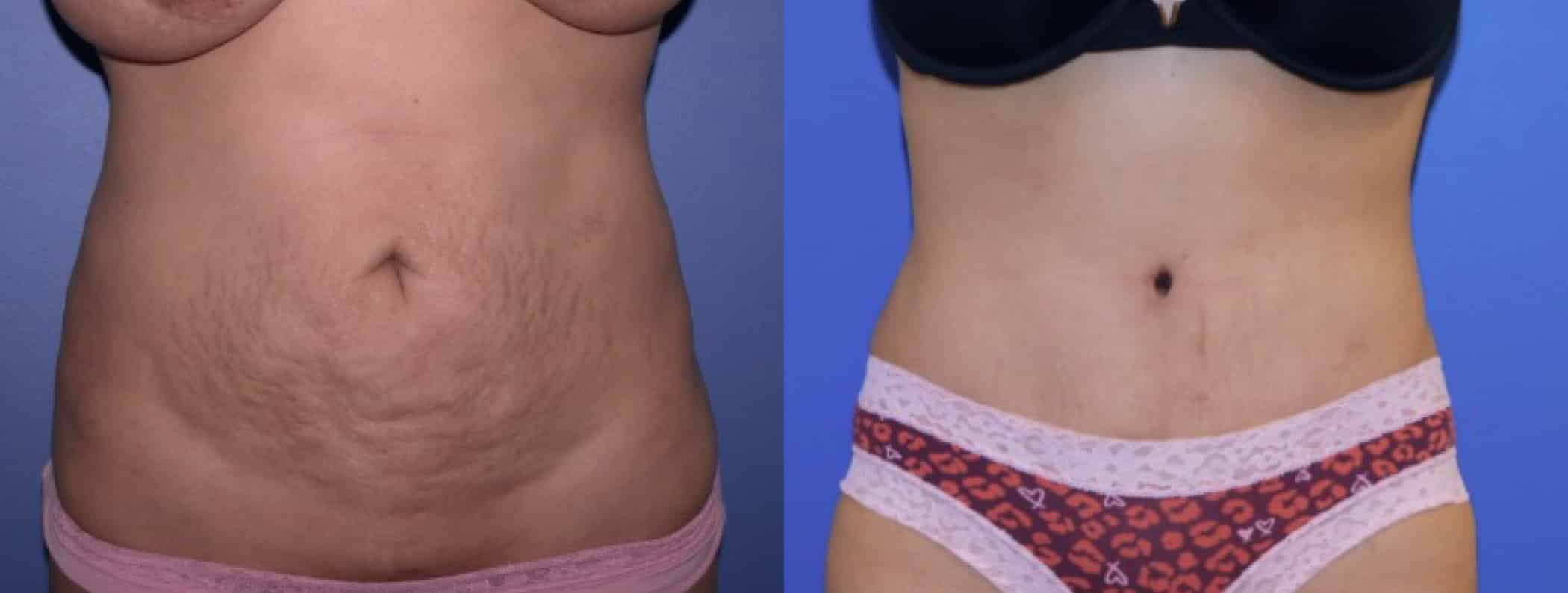Before and After Image: Tummy Tuck - front
