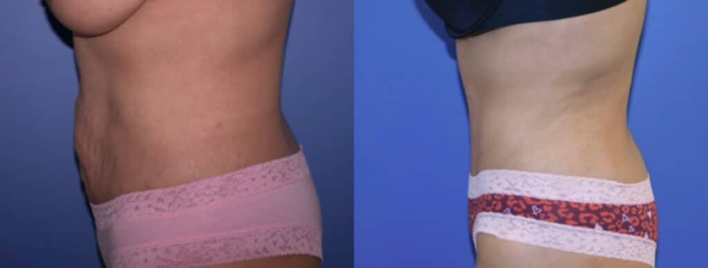 Before and After Image: Tummy Tuck - left-side