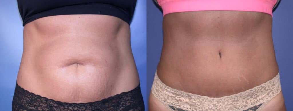 Before and After Image: Tummy Tuck - front