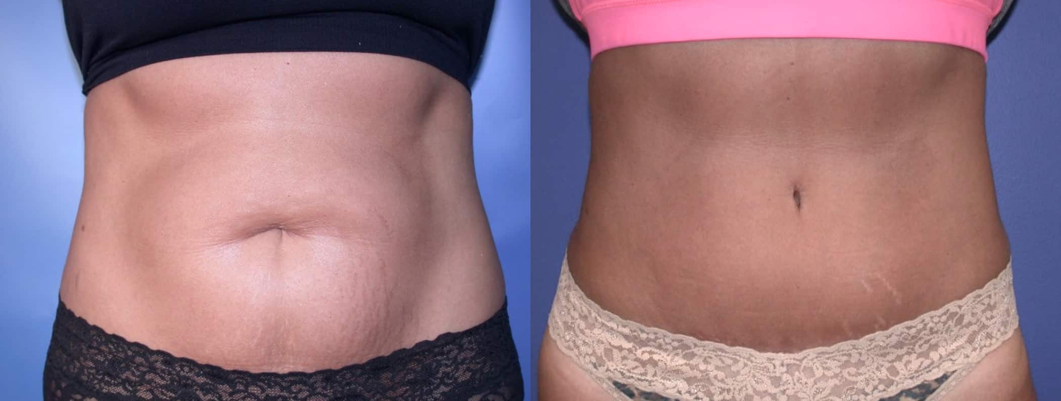 Before and After Image: Tummy Tuck - front