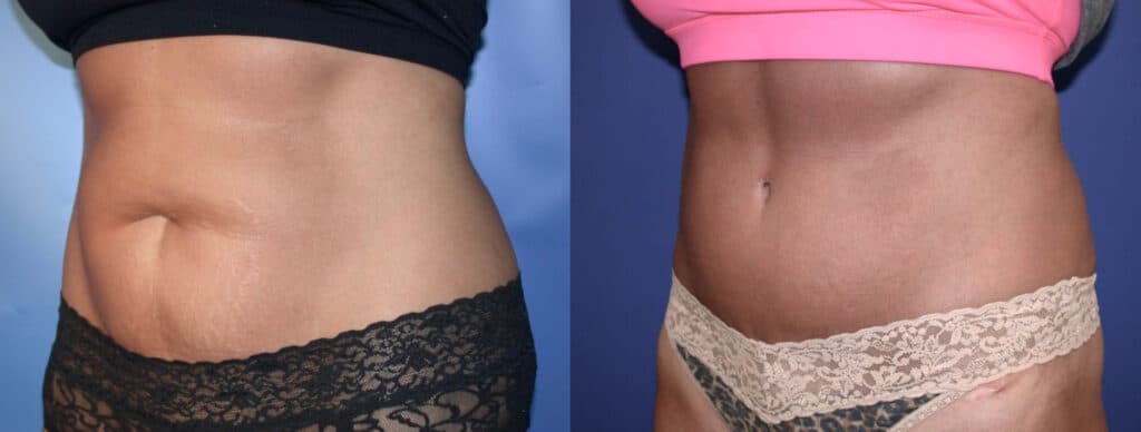 Before and After Image: Tummy Tuck - left-front-oblique