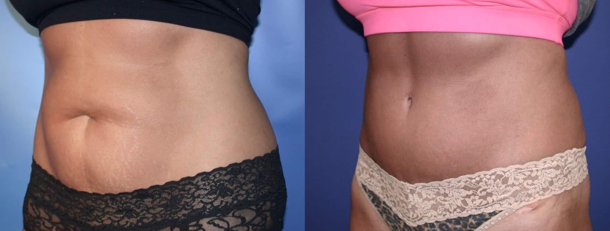 Before and After Image: Tummy Tuck - left-front-oblique