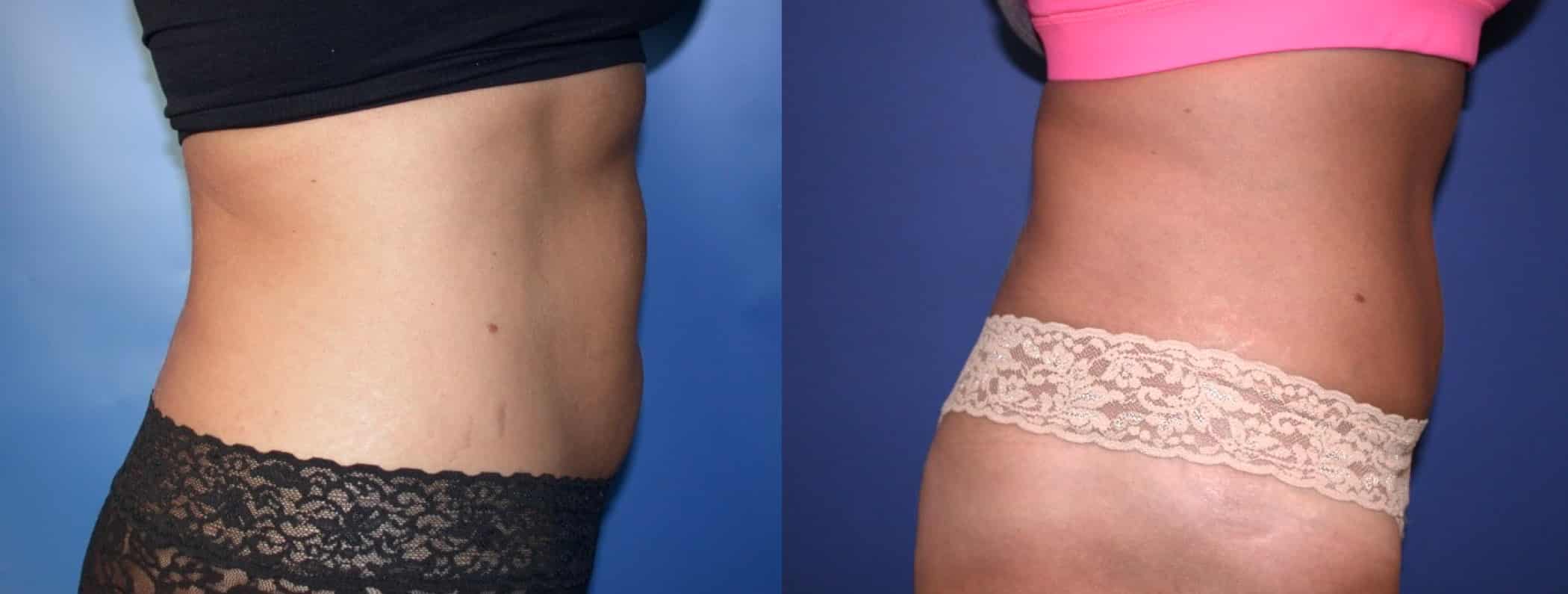 Before and After Image: Tummy Tuck - right-side