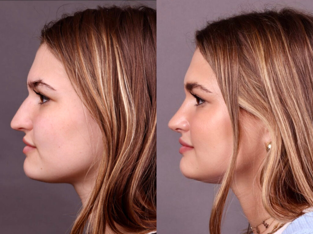 Before and After Image: Rhinoplasty - left-side