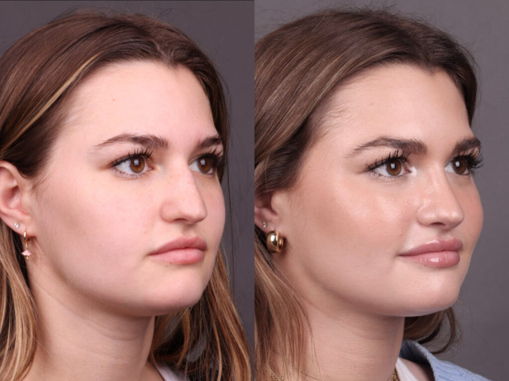 Before and After Image: Rhinoplasty - right-front-oblique