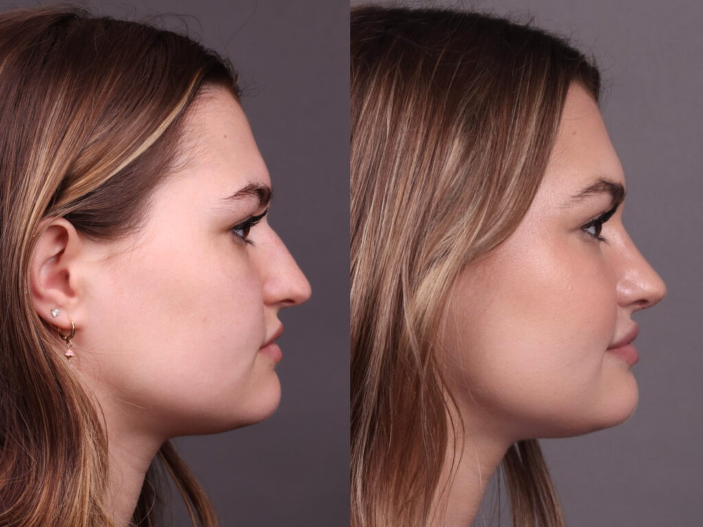 Before and After Image: Rhinoplasty - right-side