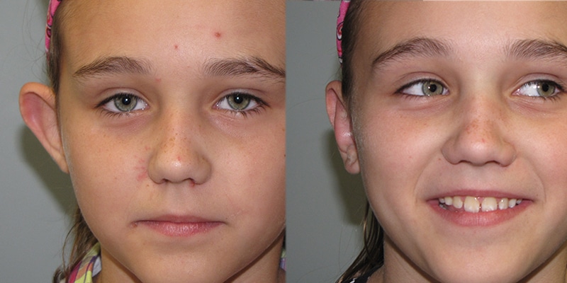 Before and After Image: Ear Surgery - front