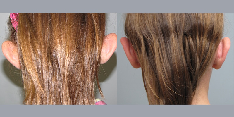 Before and After Image: Ear Surgery - back