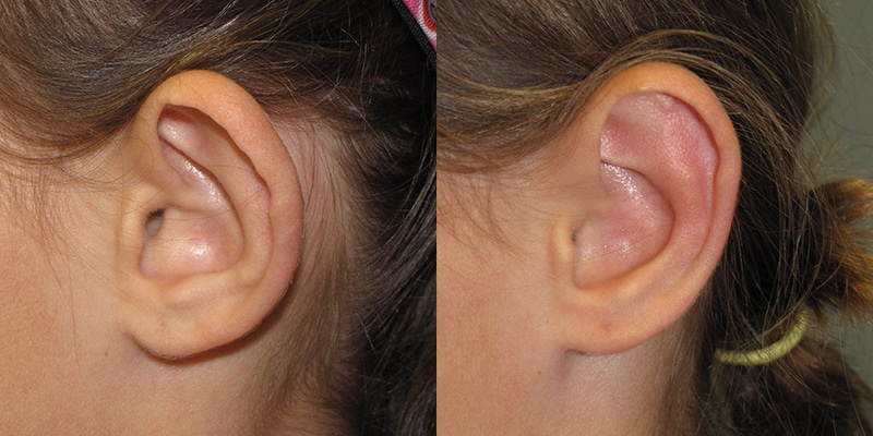 Before and After Image: Ear Surgery - left-side