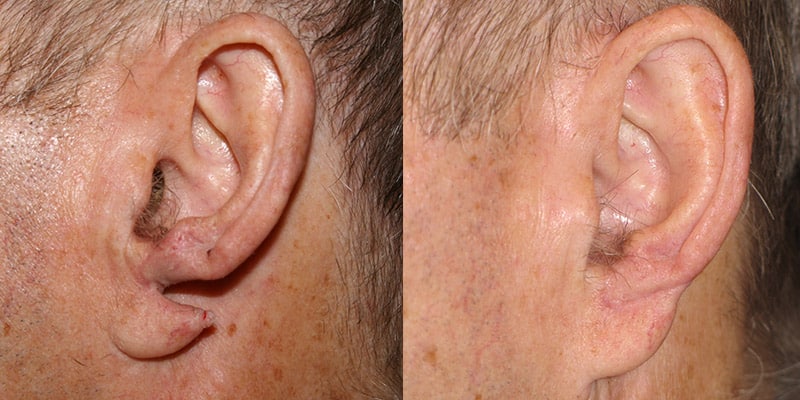 Before and After Image: Ear Surgery - left-side