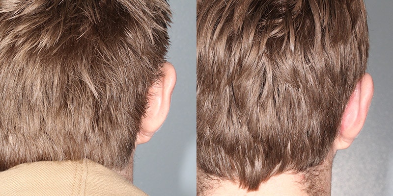 Before and After Image: Ear Surgery - back