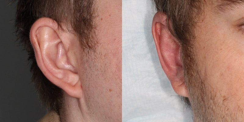Before and After Image: Ear Surgery - right-front-oblique