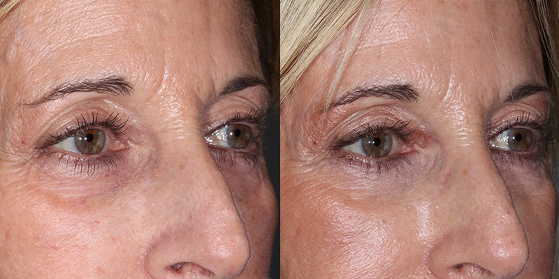 Before and After Image: Eyelid Rejuvenation - right-front-oblique