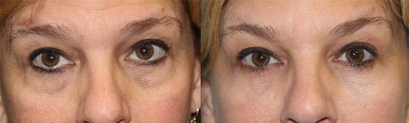 Before and After Image: Eyelid Rejuvenation - front