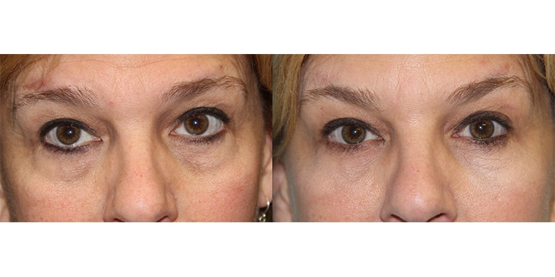 Before and After Image: Botox & Fillers - front