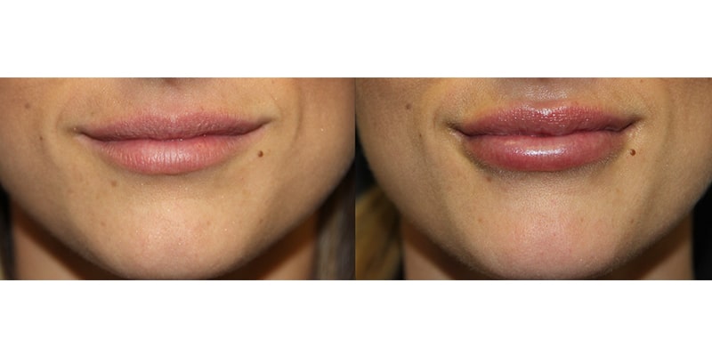 Before and After Image: Botox & Fillers - front