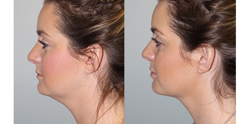 Before and After Image: Botox & Fillers - left-side
