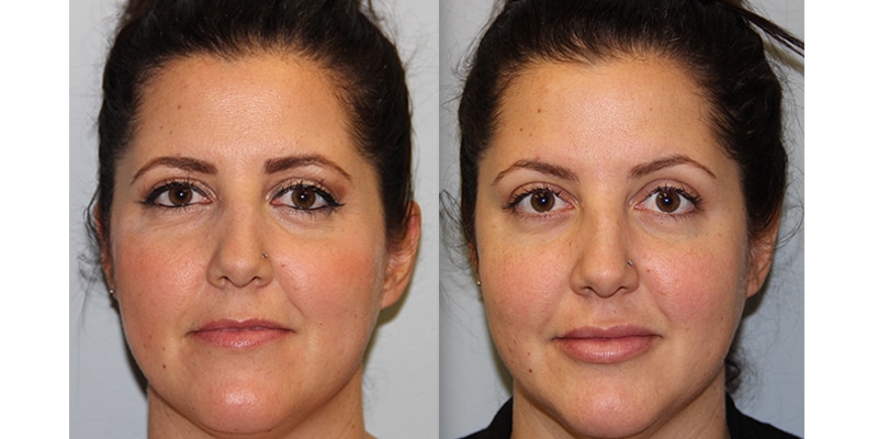 Before and After Image: Botox & Fillers - front