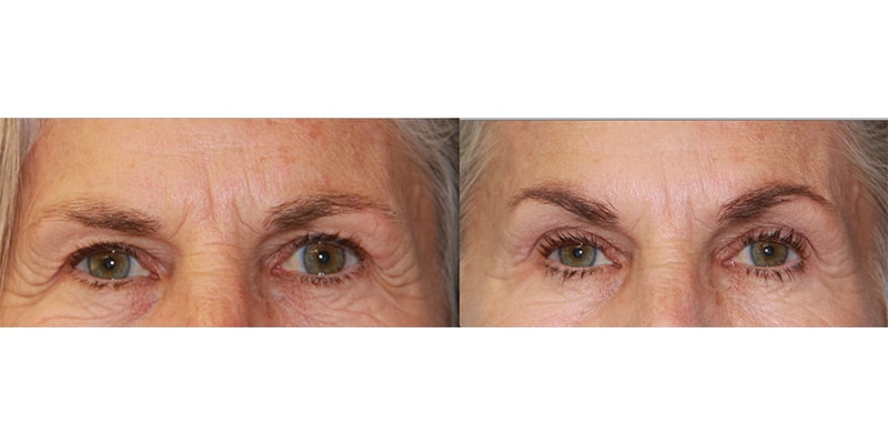 Before and After Image: Eyelid Rejuvenation - front