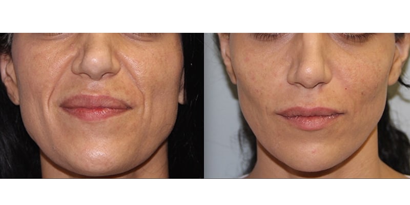 Before and After Image: Botox & Fillers - front