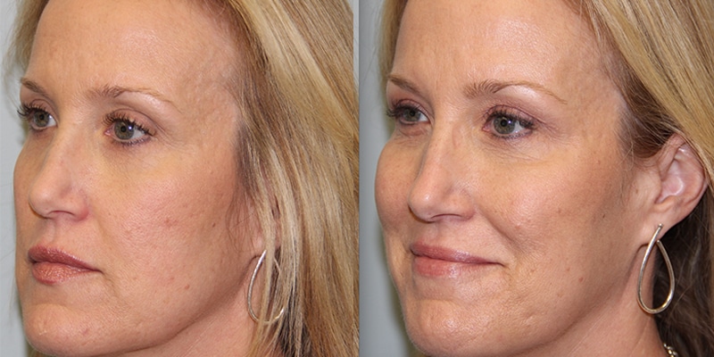 Before and After Image: Botox & Fillers - left-front-oblique