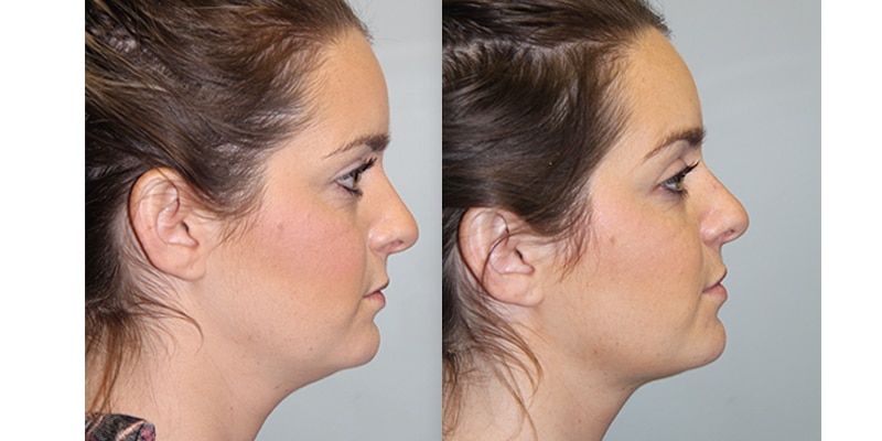 Before and After Image: Botox & Fillers - right-side