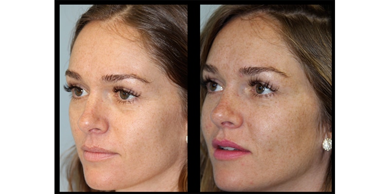Before and After Image: Botox & Fillers - left-front-oblique