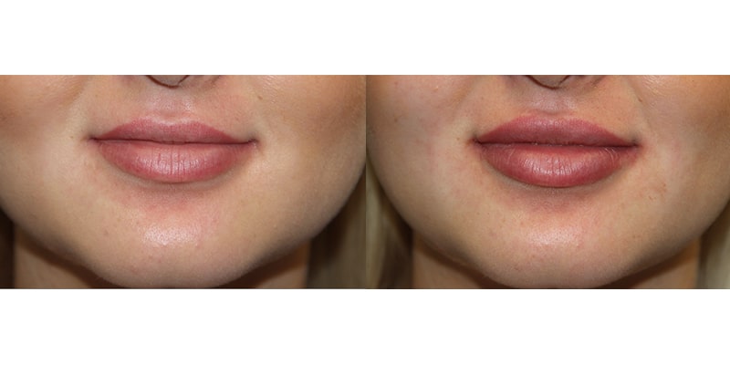 Before and After Image: Lip Enhancement - front