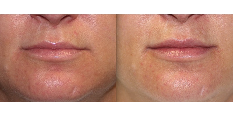 Before and After Image: Lip Enhancement - front