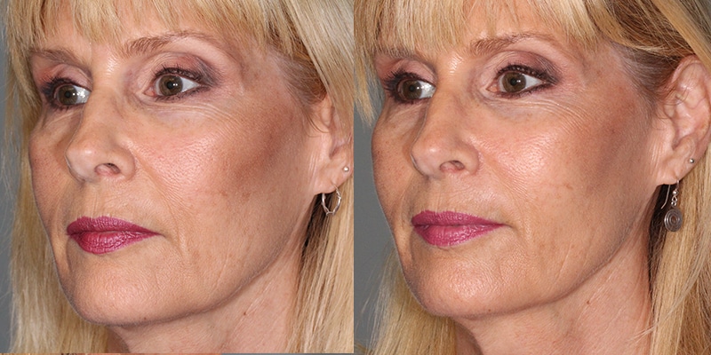 Before and After Image: Botox & Fillers - left-front-oblique