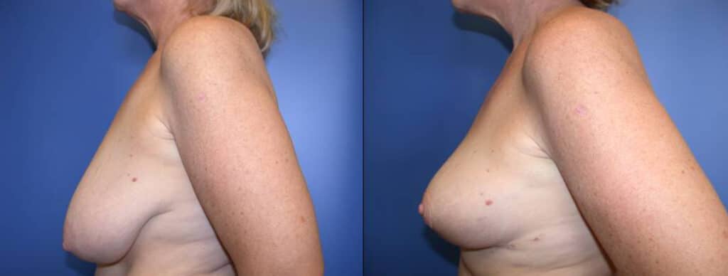 Before and After Image: Breast Reduction - left-side