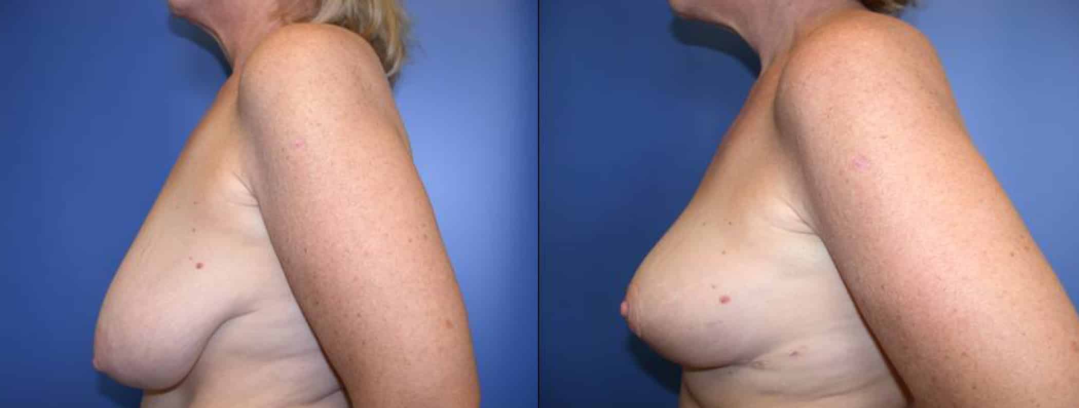 Before and After Image: Breast Reduction - left-side