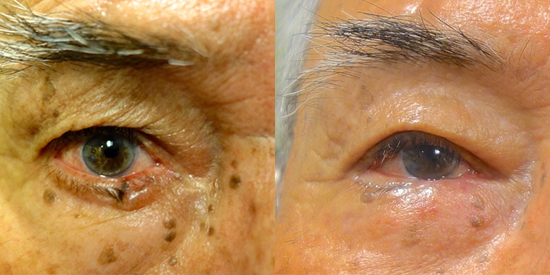 Before and After Image: Scar Treatments - front