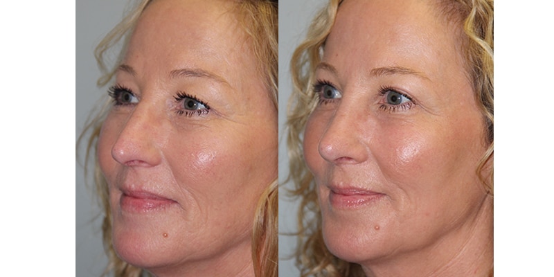 Before and After Image: CO2 Laser Resurfacing - left-front-oblique