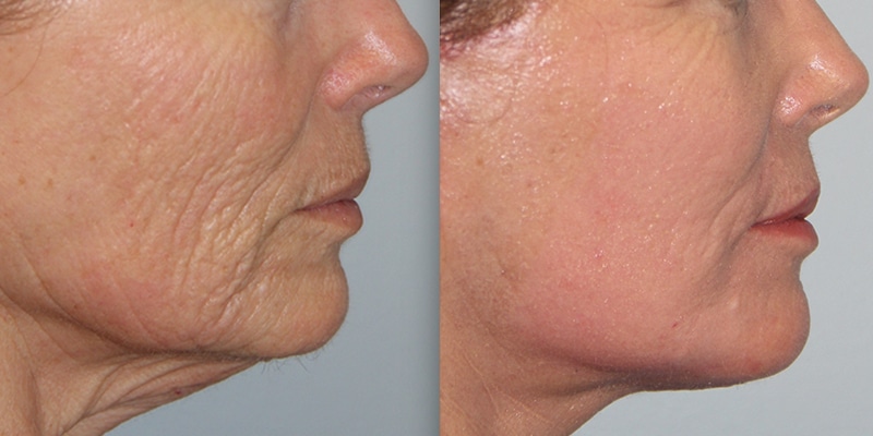 Before and After Image: CO2 Laser Resurfacing - right-side