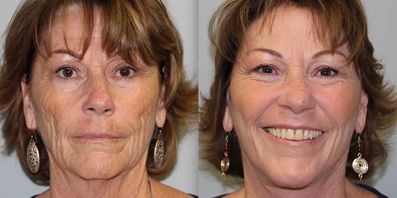 Before and After Image: CO2 Laser Resurfacing - front