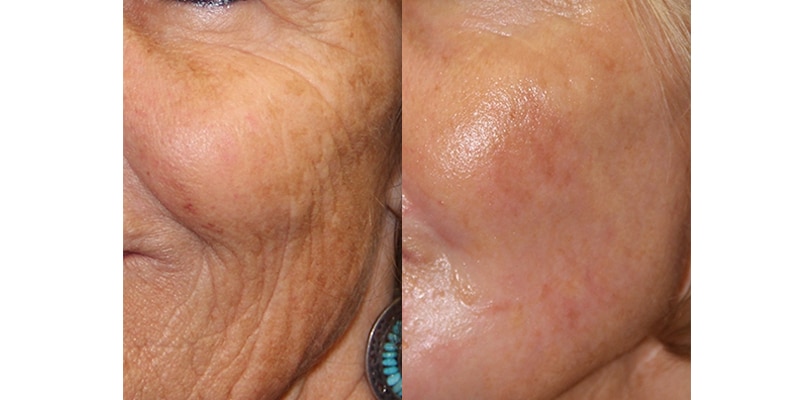 Before and After Image: CO2 Laser Resurfacing - left-front-oblique