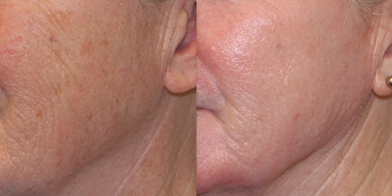 Before and After Image: CO2 Laser Resurfacing - left-front-oblique