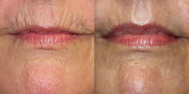 Before and After Image: CO2 Laser Resurfacing - front