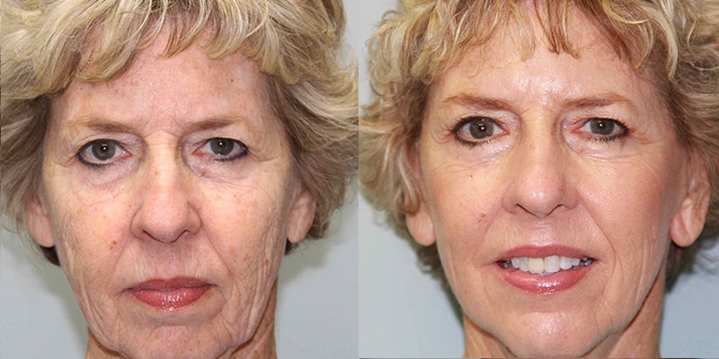Before and After Image: CO2 Laser Resurfacing - front