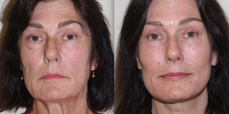 Before and After Image: CO2 Laser Resurfacing - front