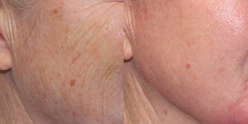 Before and After Image: CO2 Laser Resurfacing - right-front-oblique