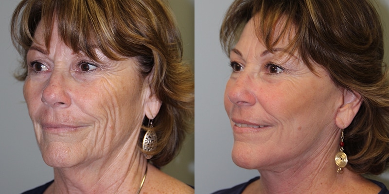 Before and After Image: CO2 Laser Resurfacing - left-front-oblique
