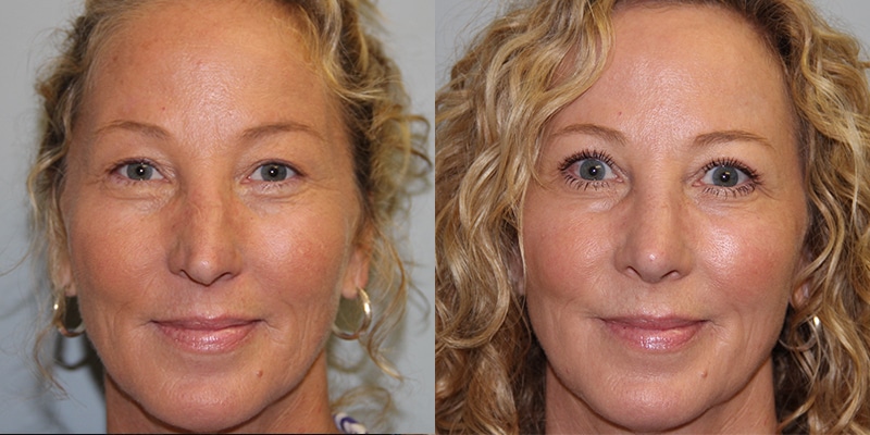 Before and After Image: CO2 Laser Resurfacing - front