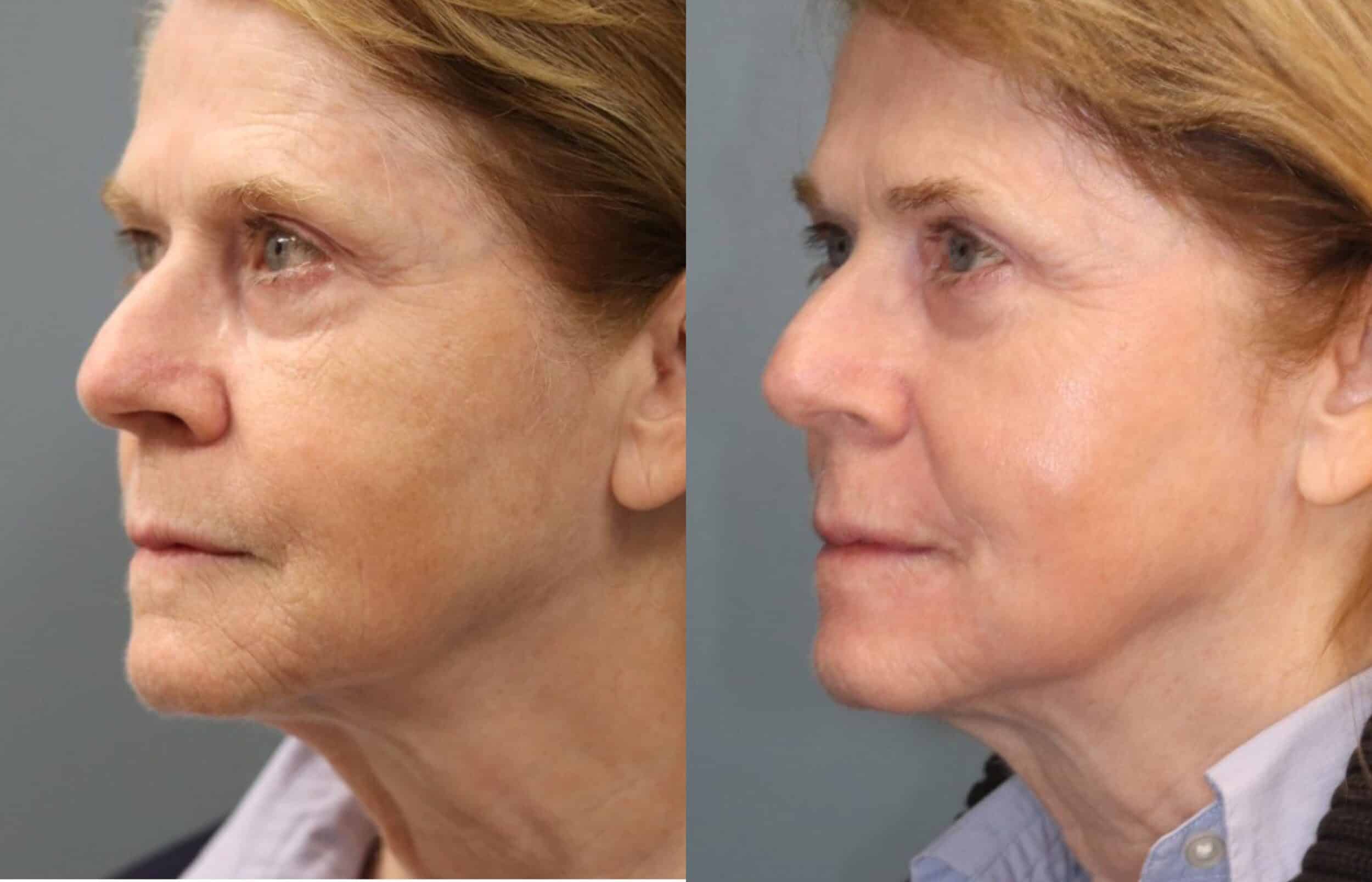 Before and After Image: CO2 Laser Resurfacing - left-front-oblique
