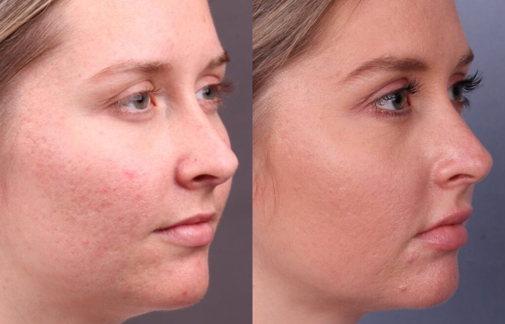 Before and After Image: CO2 Laser Resurfacing - right-front-oblique