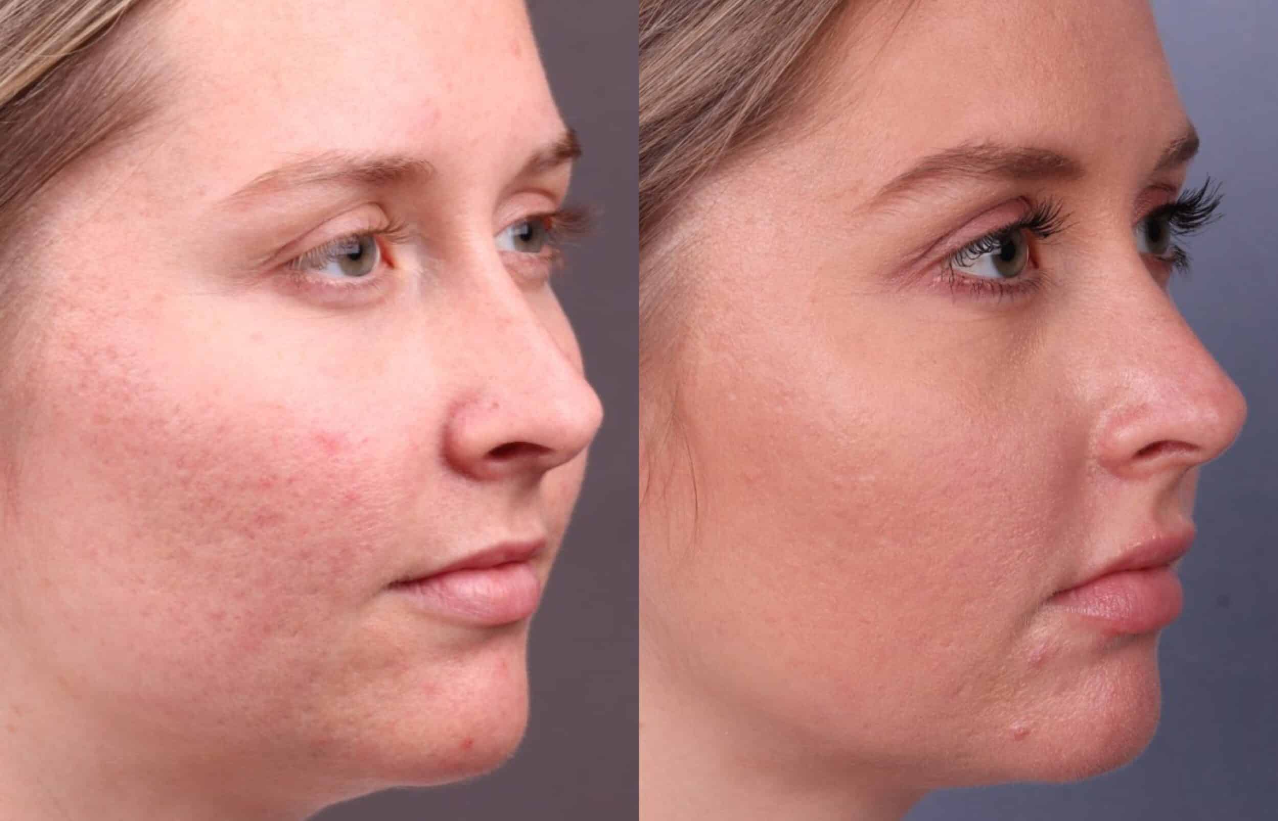 Before and After Image: CO2 Laser Resurfacing - right-front-oblique