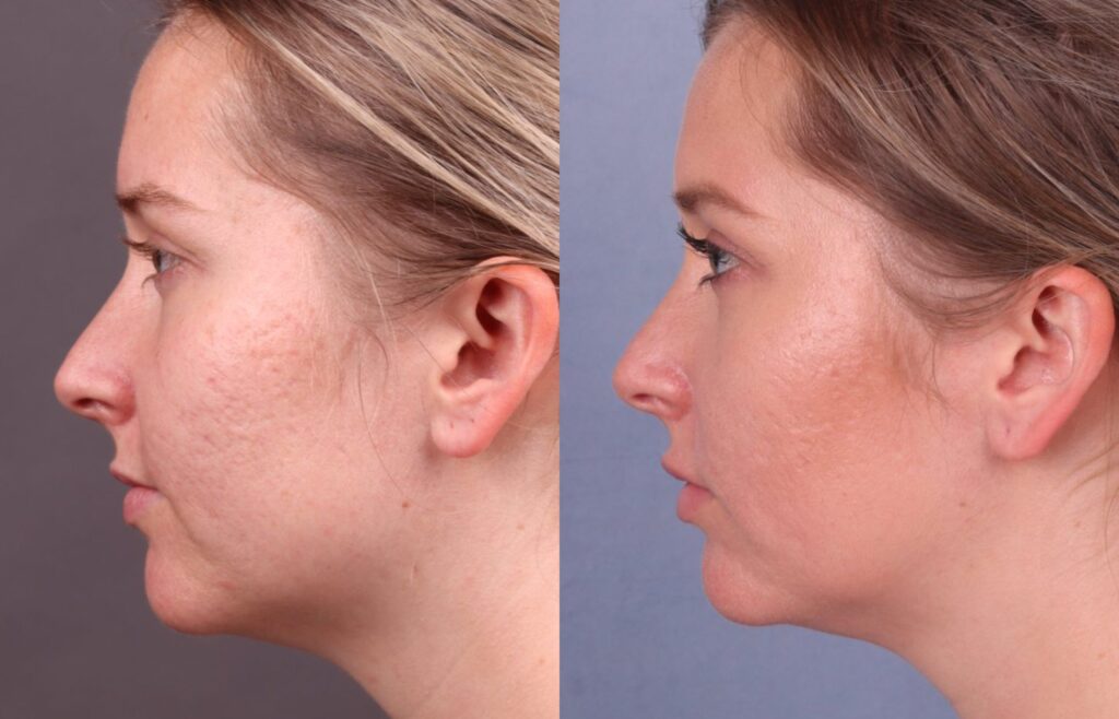 Before and After Image: CO2 Laser Resurfacing - left-side
