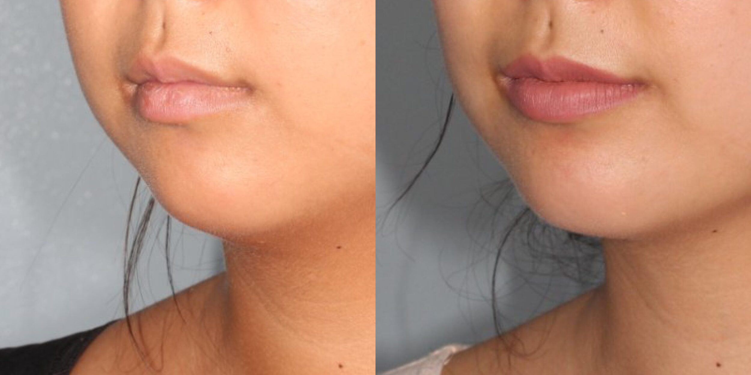 Before and After Image: Chin Surgery, Submentoplasty - left-front-oblique